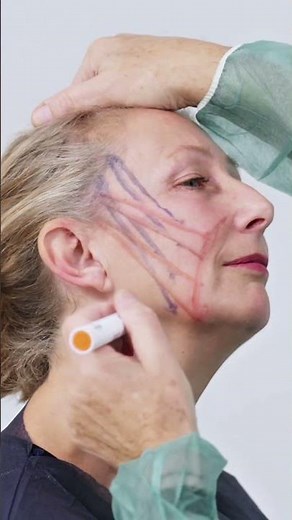 Dr Sebagh 3D Thread Lift – Instant, Non-Surgical Results