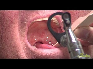 Endoscopic Sinus Surgery | Pasha Snoring & Sinus Center
