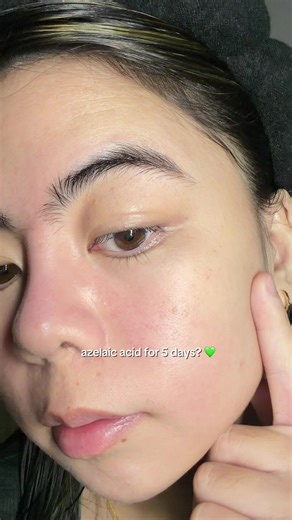 Effective Azelaic Acid Serum for Redness and Breakouts