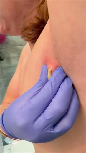 Big ol abscess under the armpit