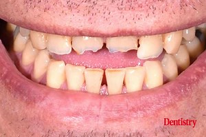 Injection moulding technique: case study - Dentistry