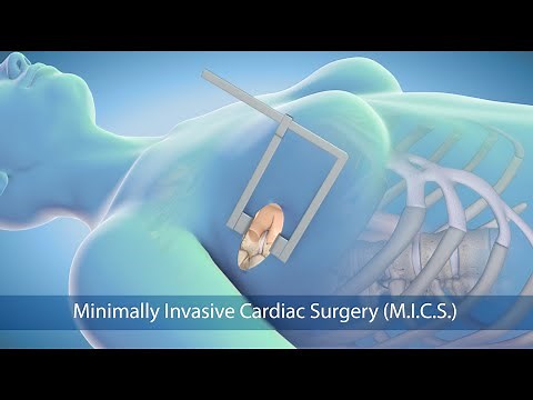 Medical Animation: Minimally Invasive Cardiac Surgery (MICS) at Sarasota Memorial Hospital