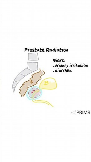 "I have prostate cancer—how does radiation therapy work, and what are its risks and side effects?”