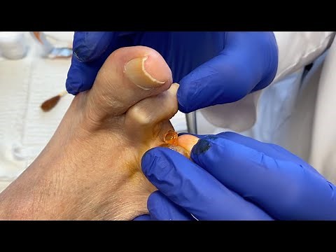 Toe Cyst Surgery