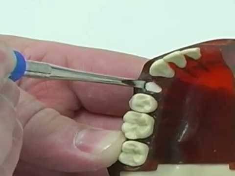 Use of a luxator to extract a broken root