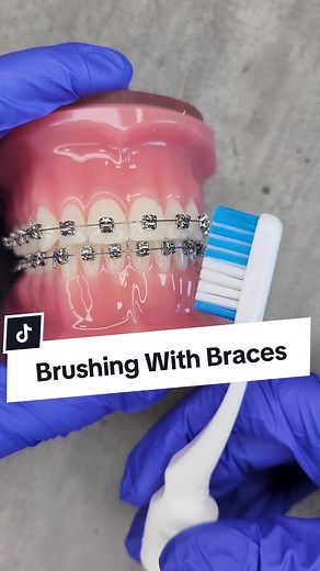 How to Brush Your Teeth with Braces Properly