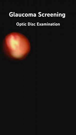 Get a closer look at the optic disc! 👁️‍🗨️ Join us for detailed tutorial on ophthalmoscopy technique