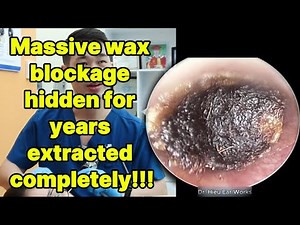 Massive wax blockage hidden for years extracted co | ear cleaning | ASMR earwax | soothing |relax|