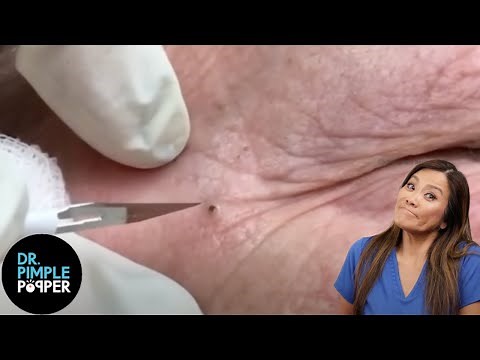 Dr Pimple Poppers Most Satisfying Soft Pops!