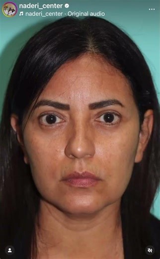 Immediate Eyelid Rejuvenation | Blepharoplasty Before & After