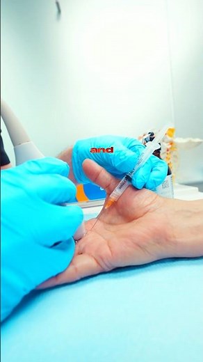 Restoring the Glide: Clinical Treatment for Trigger Finger 🤚⚙️ #painrelief #recovery