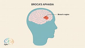 Broca's Aphasia