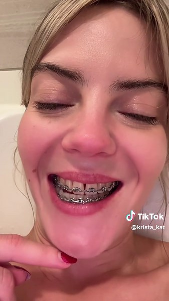 Getting my braces off in a few months 🤞🏻 | braces