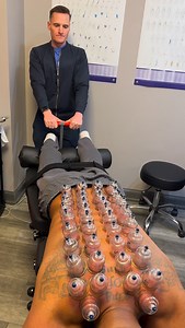 🏆 cupping therapy flexion-distraction. While the flexion-distraction table gently decompresses the spine, cupping therapy works on the surface to improve blood flow, reduce muscle tension, and release stubborn fascia. Together, they target both deep spinal structures and surface tension for next-level results. 🙌 #CuppingTherapy #FlexionDistraction #LowBackPainRelief #SpinalHealth #ChiropracticCare #SportsRecovery | Dr_kyleross