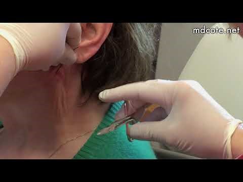 Neck Lifting and Tightening with Nova Threads