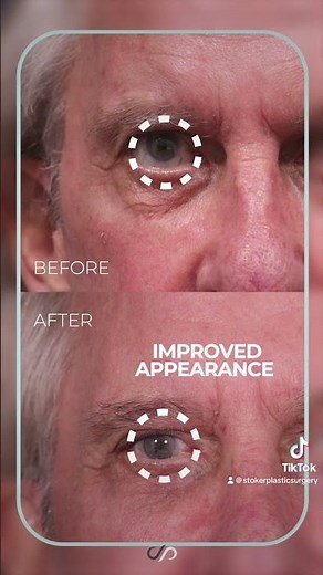 The Secret to a Stunning Upper Eyelid Transformation