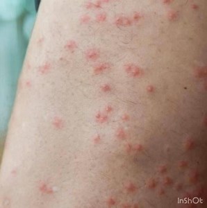 How To Identify 10 Of The Most Common Bug Bites, | Online News 24