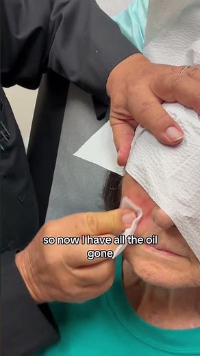 Dermatologist with 50 years of experience explains why you use acetone before TCA Peels 👨🏻‍⚕️