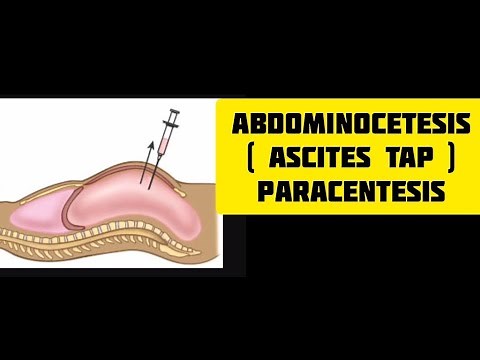 Ascites tap procedure || paracentesis || abdominocetesisn# medics skills #shorts