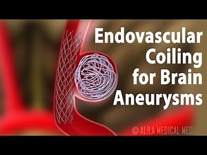 Endovascular Coiling for Brain Aneurysm • Video • MEDtube.net