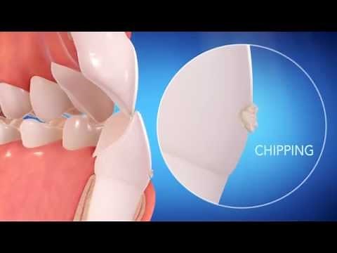 Invisalign Straight Talk Video