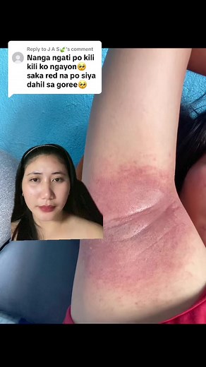 Effective Treatment for Itchy Underarms | Zudaifu Cream Review