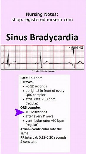 Sinus Bradycardia ECG EKG Nursing: Treatment, Rhythm Made Easy in Less Than 1 Minutes #nursing #ecg