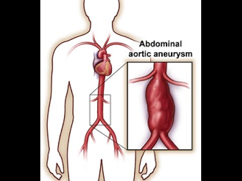 Abdominal Aortic Aneurysm (AAA)