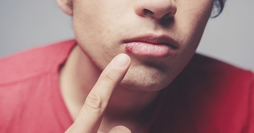 World Health Organization: Most people have herpes