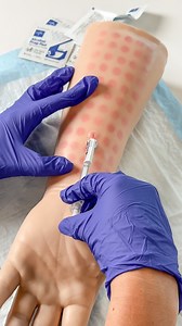 Bleb, bleb, go away, come back again another day... or don’t 💉 💉Mantoux tuberculin skin test (TST) Screening tool to assess for tuberculosis (TB) or latent infection. A small amount of tuberculin is injected beneath the skin and forms a bleb, which is expected! ➕🟢 Positive ( ) test ≥ 5mm, redness, raised, hard, swelling where fluid was injected Indicates the patient was exposed to TB & further testing is needed ➖🔴Negative (-) test No bump or a tiny bump “bleb” where fluid was injected Indica