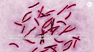 Tuberculosis outbreak in Kansas: What you need to know