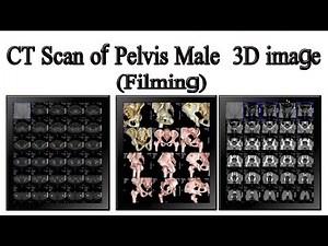 CT scan of male pelvis with 3D image