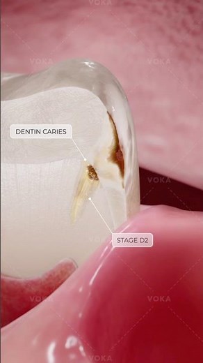 What is dental caries and how does it develop? Explore dentistry in 3D