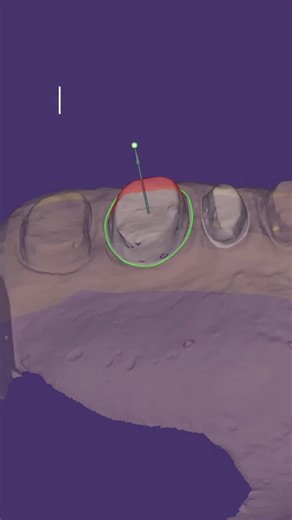 Exocad Tips for Dental Professionals