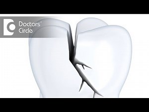 How to manage if Root Canal treated tooth gets fractured? - Dr. Jayaprakash Ittigi