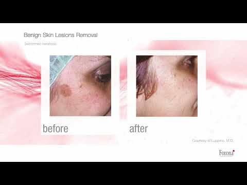 Benign Skin Lesions Removal with Laser