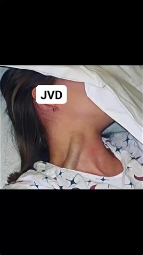7.8K views · 17 reactions | Jugular vein distention (JVD) is swelling of the vein that runs down the right side of the neck. This happens when blood is unable to flow as it should. The blood backs up in the vein, increasing jugular vein pressure, or JVP. JVD is usually a sign of heart failure, which often involves high blood pressure. #reels #everyone #viral #highlights #explore #contentmonitezation | Marycynthia Ugoh | Facebook
