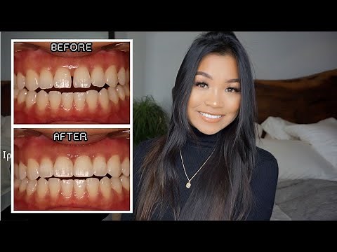 TEETH BONDING FOR GAPS/CHIPPED TEETH! PRICING, PROCESS, & UP CLOSE BEFORE AND AFTER! | XOJENNYDEY