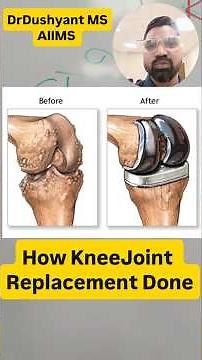 Total Knee Replacement Explained Simply | Complete Guide for Patient |