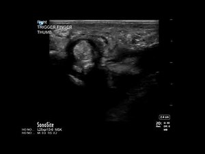 Wrist Ultrasound: Trigger Finger Thumb Injection