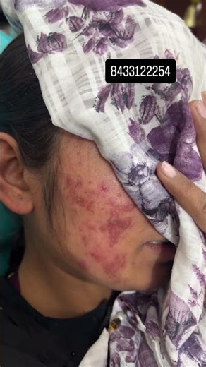 Nodular cystic acne treatment reviews 🌸 #aestheticabydrneha #ytshorts