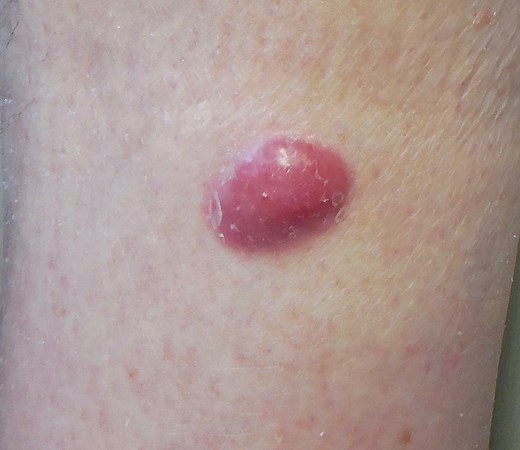Merkel Cell Carcinoma Warning Signs and Images