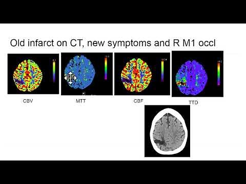 Video 3 of 3: How to Interpret a Brain CT Perfusion Scan for acute stroke