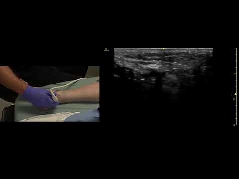 Ultrasound of the Posterior Tibial Artery and Nerve
