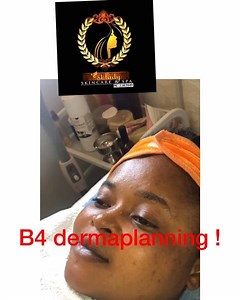10K views · 39 reactions | FULL VIDEO! DERMAPLANNING...