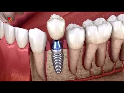 Dental Implant Procedure Explained in 10 Seconds- 3D Animation. #implantinsylhet #explore