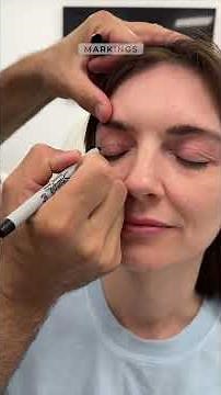 In office upper blepharoplasty