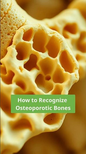 Spotting Osteoporotic Bones: What to Look For 🦴