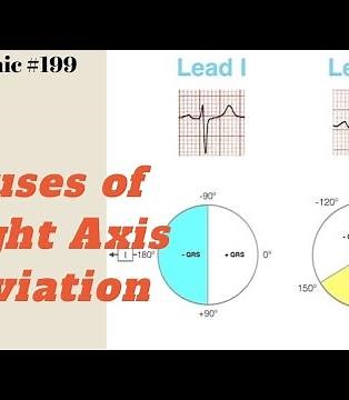 Causes of Right Axis Deviation ECG Mnemonic