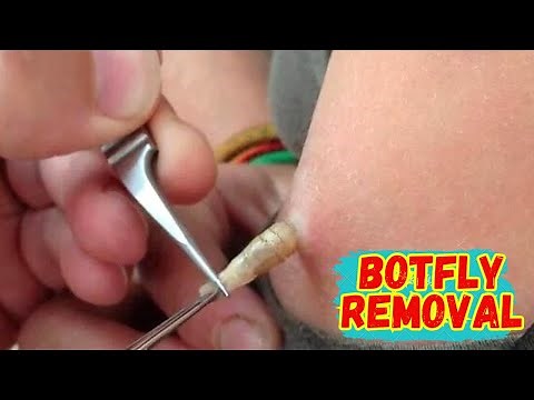 Botfly Removal Nightmares! What's the SAFEST Method for Humans?